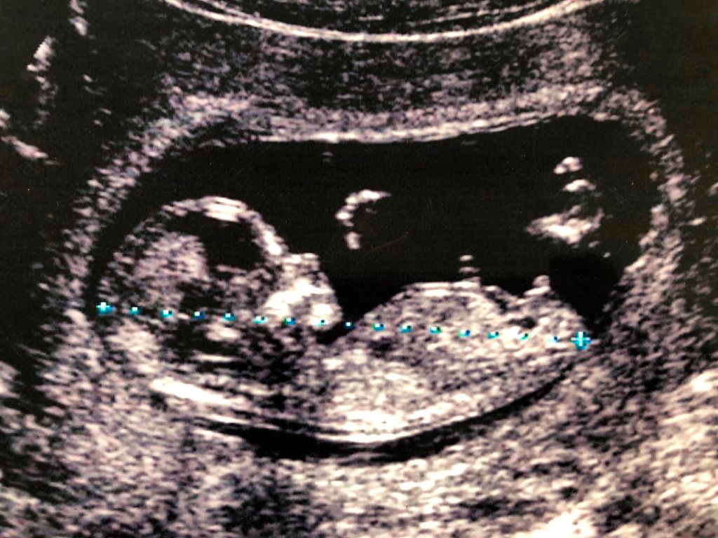 University Facilitated Gruesome, Taxpayer-Funded Experiments With Aborted Fetuses 1
