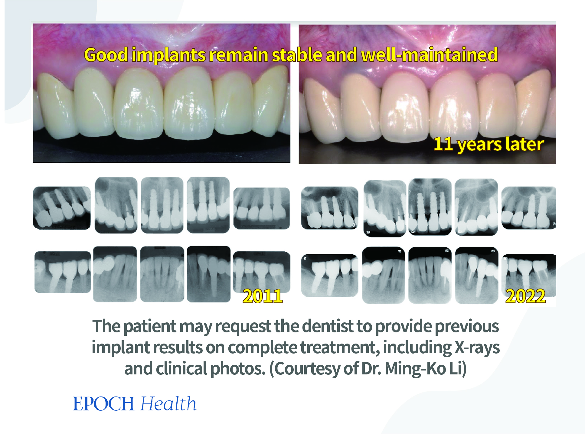 Top Reasons Dental Implants Fail, and What to Look for in a Dentist Conservative News Daily™